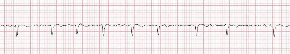 ECG tracing: af.png