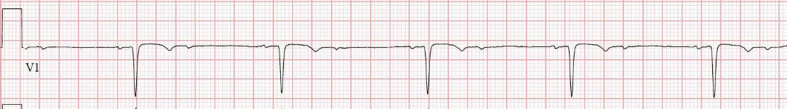 2:1 AV block (V1) — every other P wave is blocked; only every second one reaches the ventricles