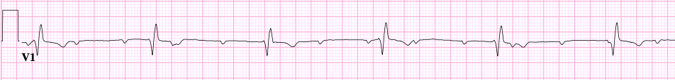 Complete heart block — independent atrial and ventricular rates