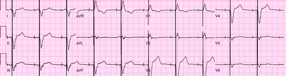 ECG tracing: paced.png