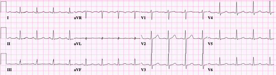 ECG tracing: sinus.png