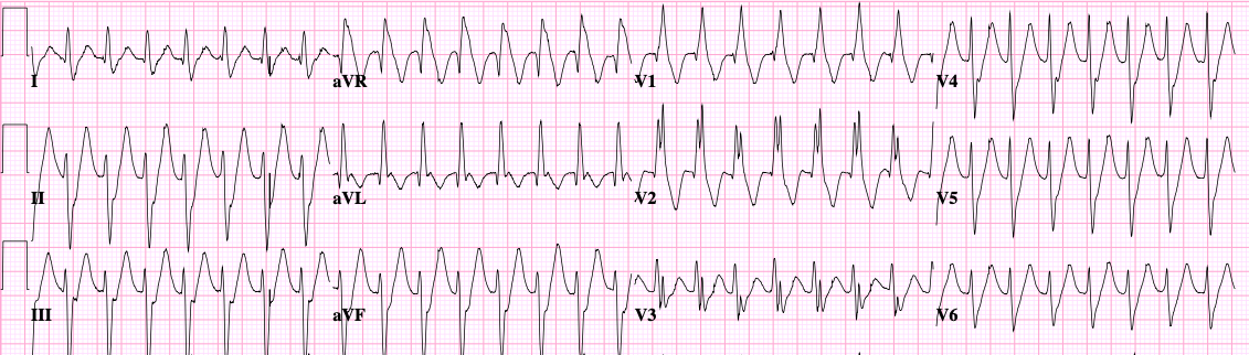 ECG tracing: vt.png